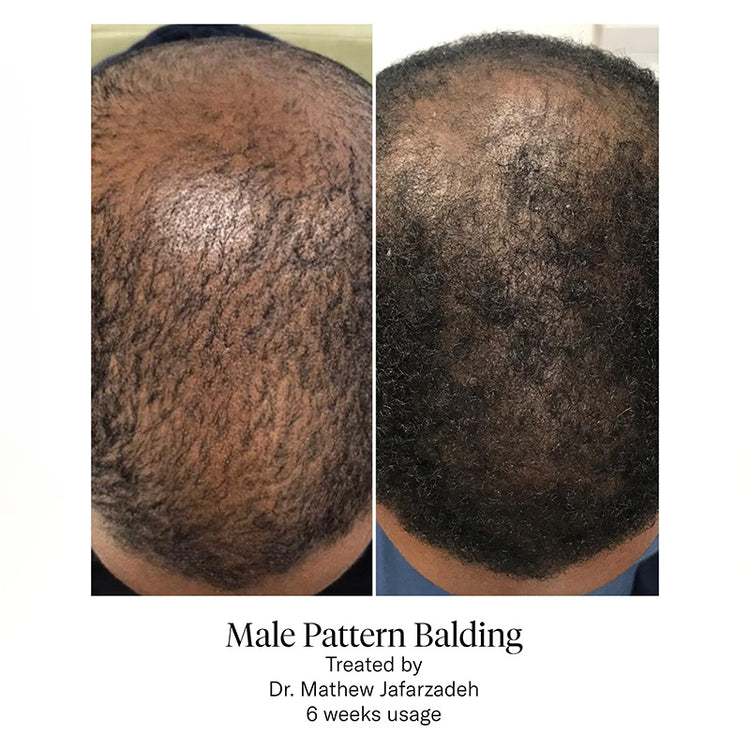 Calecim Professional Hair Serum Kit