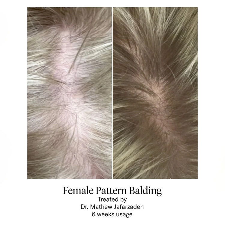 Calecim Professional Hair Serum Kit