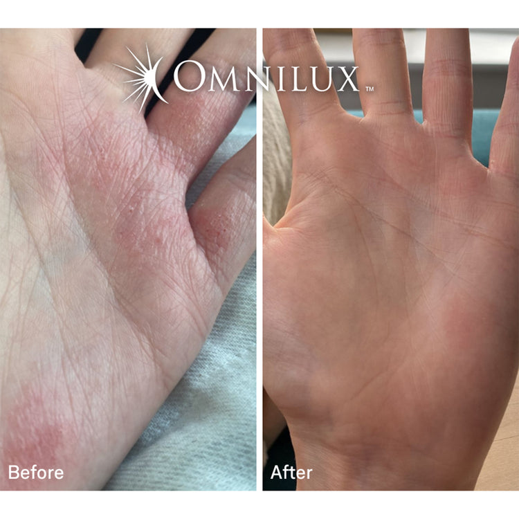 Omnilux Contour Glove Duo
