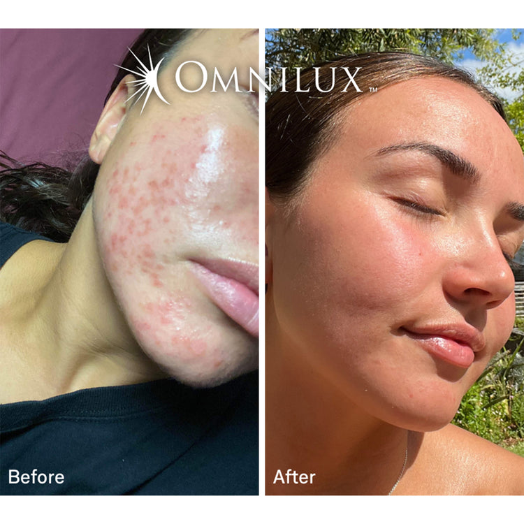 Omnilux Clear Face