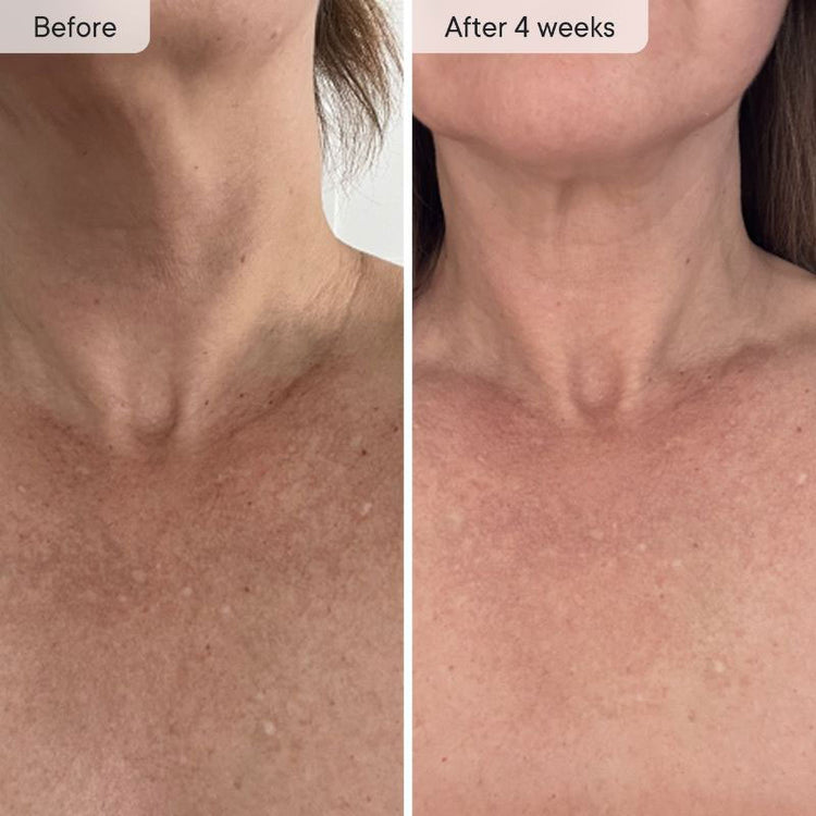Qure Skincare Q-Rejuvalight Pro LED Mask + Neck & Decolletage LED System Bundle