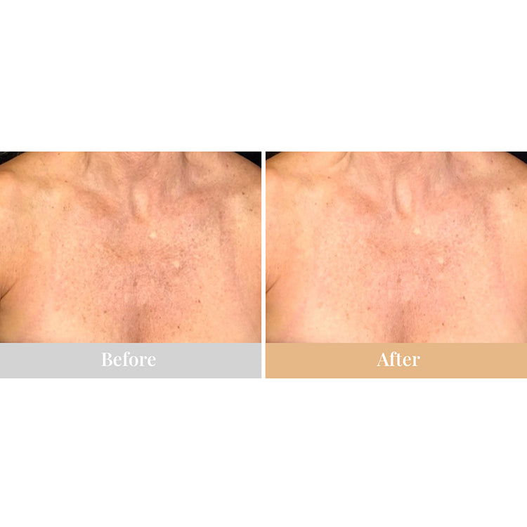 Omnilux Contour Neck & Décolleté