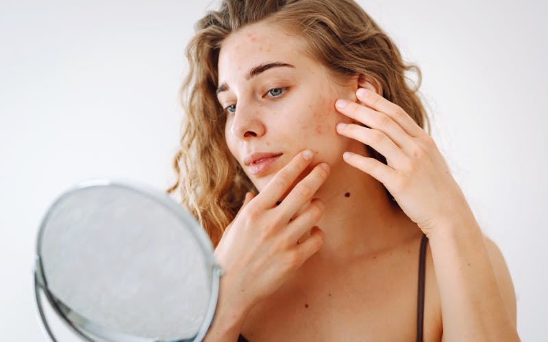 Stress Related Skin Conditions