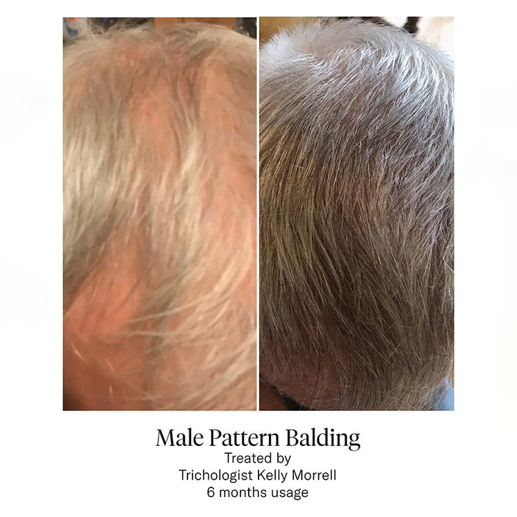 Calecim Professional Hair Serum Kit