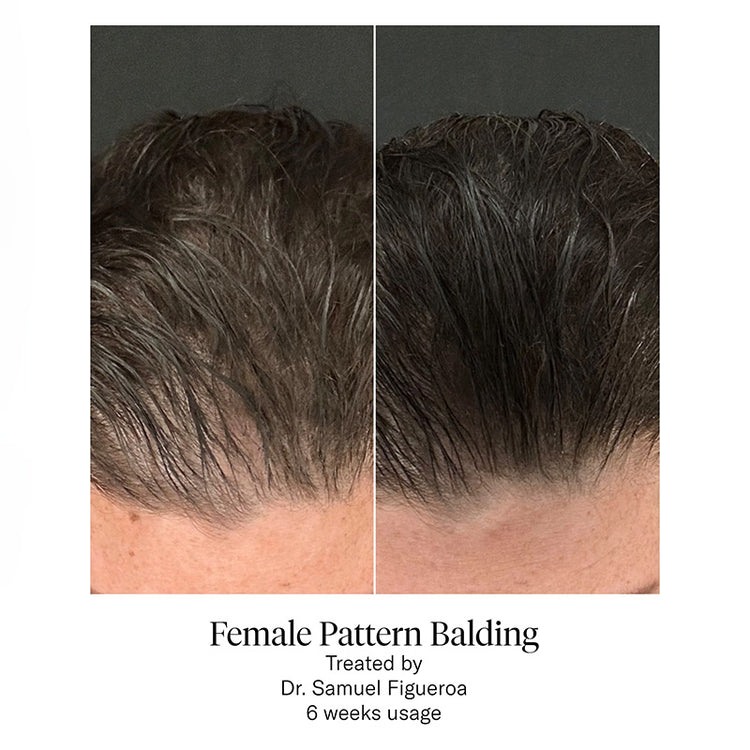 Calecim Professional Hair Serum Kit
