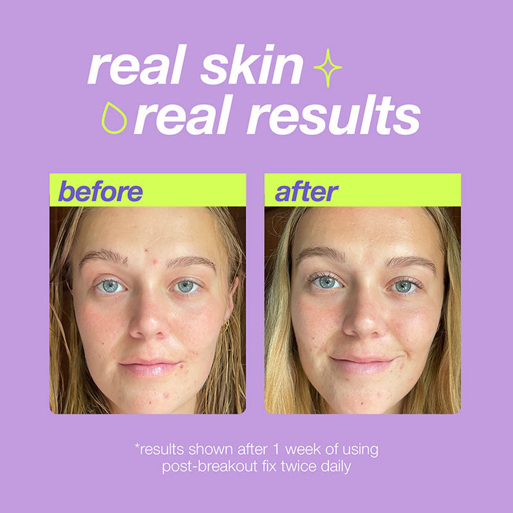 Dermalogica Clear Start Post-Breakout Fix 15ml