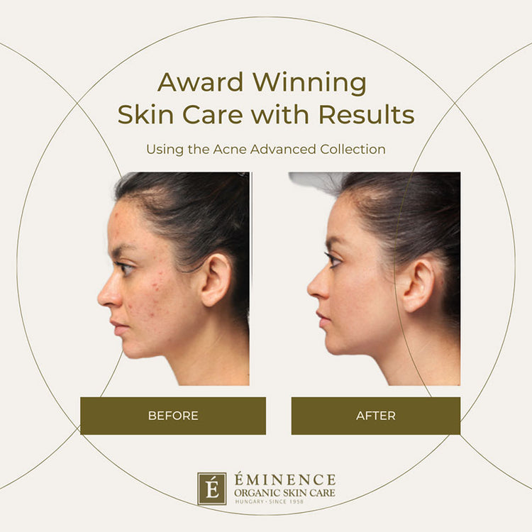 Eminence Acne Advanced Treatment System