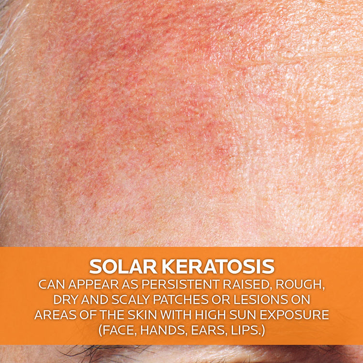 La Roche-Posay Anthelios KA+ Sunscreen SPF 50+ 50ml