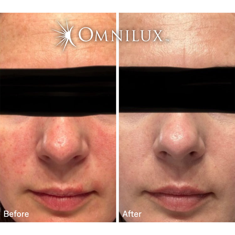 Omnilux Contour Face