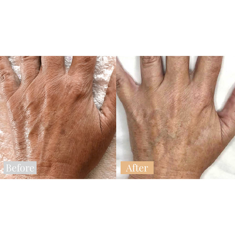 Omnilux Contour Glove Duo