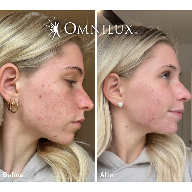 Omnilux Clear Face