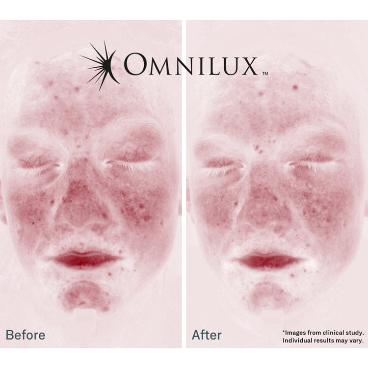 Omnilux Clear Face