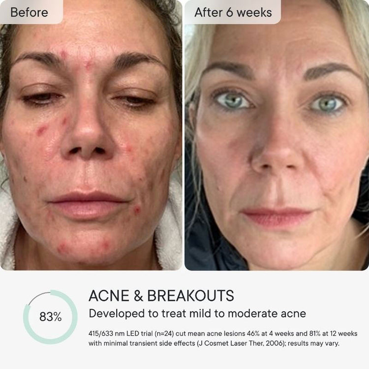Qure Skincare Q-Rejuvalight Pro LED Mask