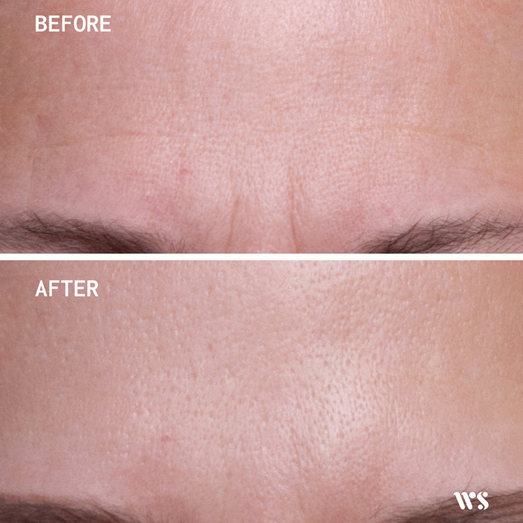 Wrinkles Schminkles Brow Frown & Bunny Lines Wrinkle Patches - 2 patches