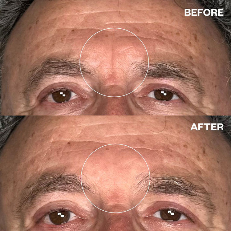 Wrinkles Schminkles Men's Pro Forehead Wrinkle Patch
