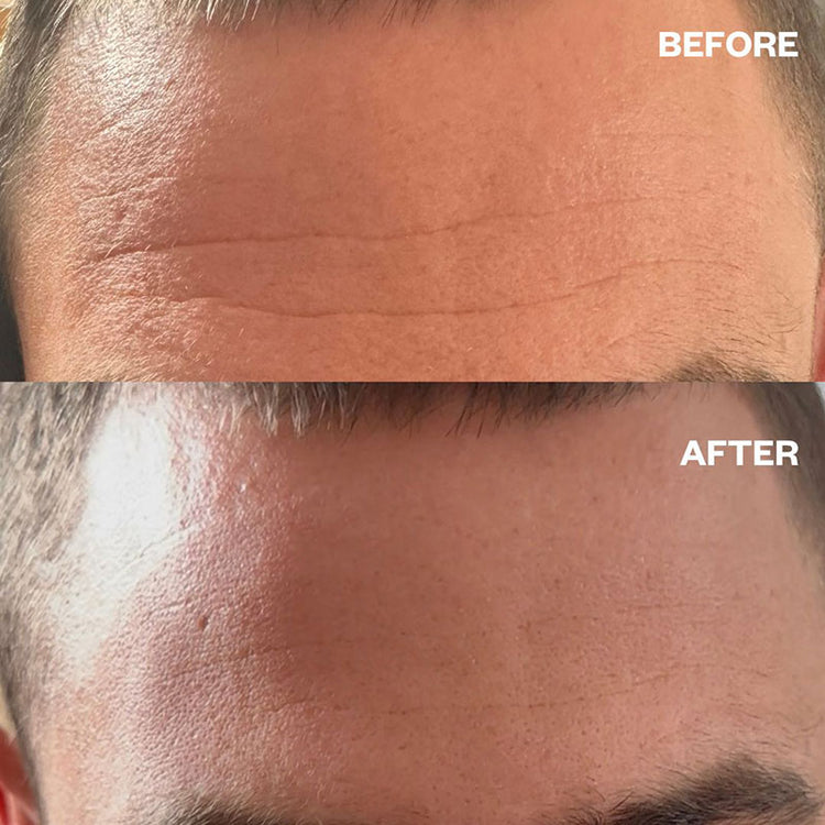 Wrinkles Schminkles Men's Pro Forehead Wrinkle Patches