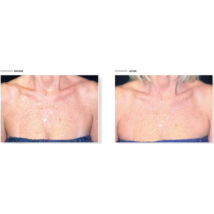 Omnilux Contour Neck & Décolleté